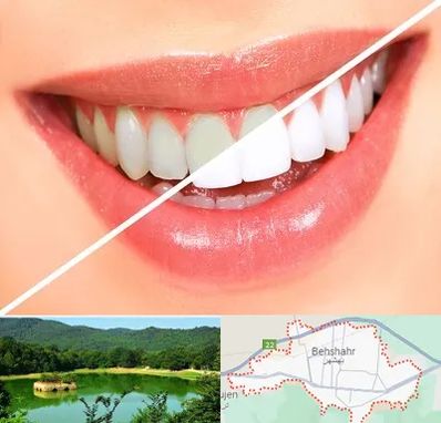 بلیچینگ دندان در بهشهر