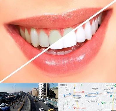 بلیچینگ دندان در پیروزی 