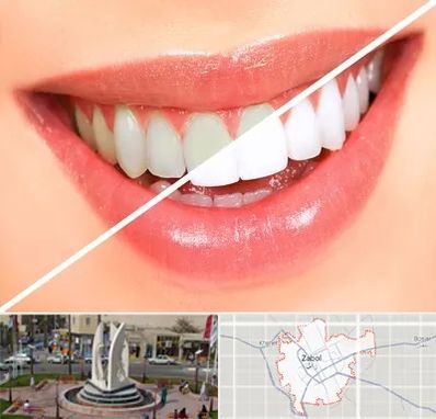 بلیچینگ دندان در زابل