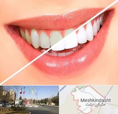 بلیچینگ دندان در مشکین دشت