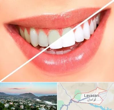 بلیچینگ دندان در لواسان
