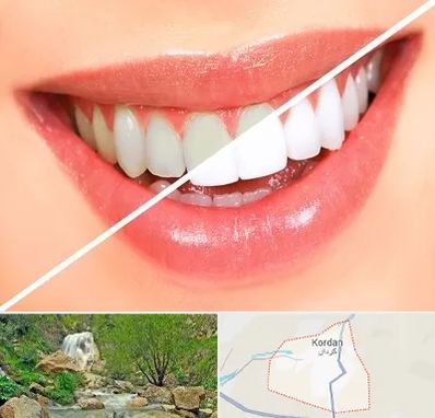 بلیچینگ دندان در کردان