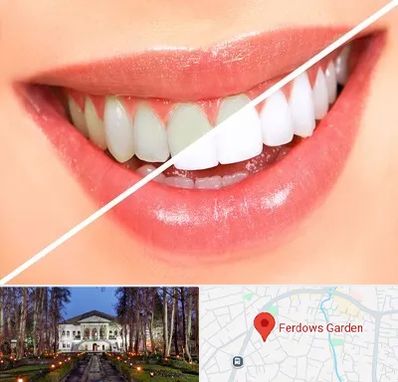 بلیچینگ دندان در باغ فردوس