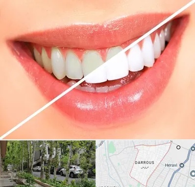 بلیچینگ دندان در دروس