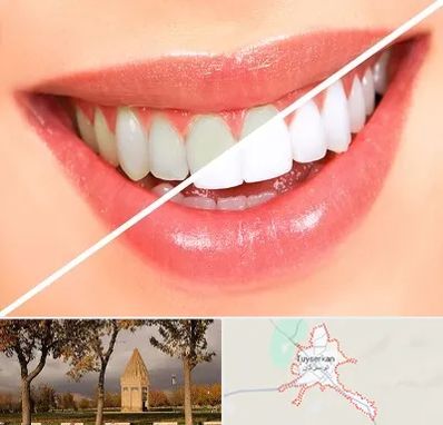 بلیچینگ دندان در تویسرکان