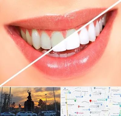 بلیچینگ دندان در میدان حر