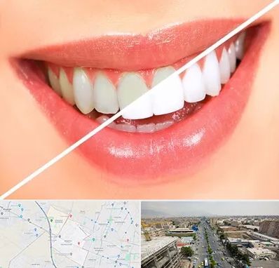 بلیچینگ دندان در حصارک کرج
