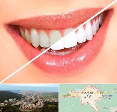 بلیچینگ دندان در گرگان
