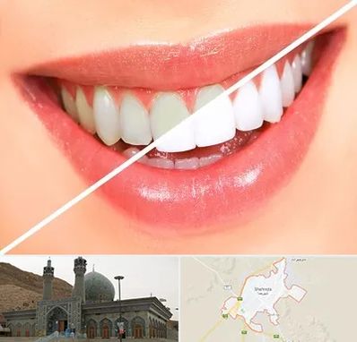 بلیچینگ دندان در شهرضا