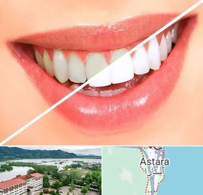 بلیچینگ دندان در آستارا