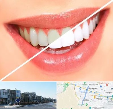بلیچینگ دندان در شریعتی مشهد
