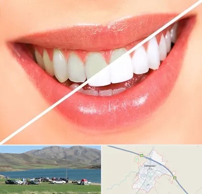 بلیچینگ دندان در دهگلان