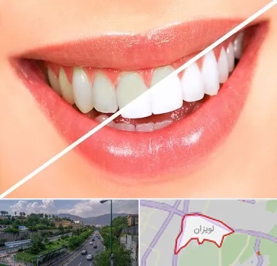 بلیچینگ دندان در لویزان