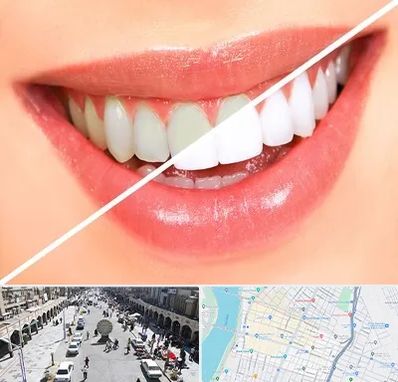 بلیچینگ دندان در نادری اهواز
