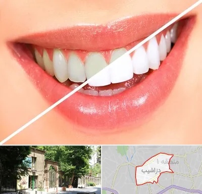 بلیچینگ دندان در دزاشیب