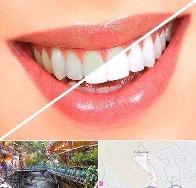 بلیچینگ دندان در درکه