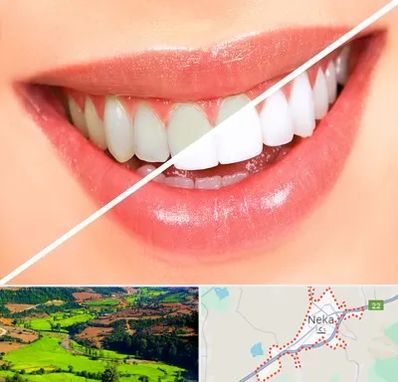 بلیچینگ دندان در نکا