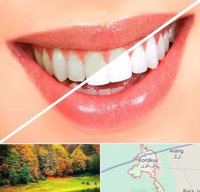 بلیچینگ دندان در کردکوی