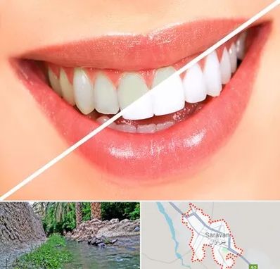 بلیچینگ دندان در سراوان