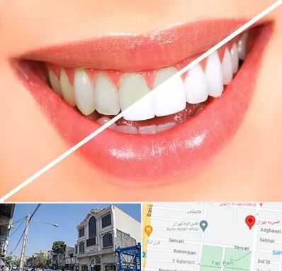بلیچینگ دندان در افسریه 