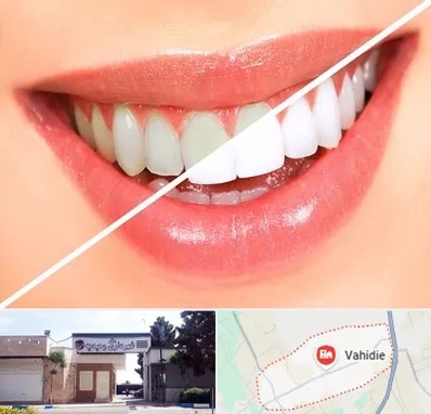 بلیچینگ دندان در وحیدیه شهریار