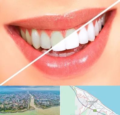 بلیچینگ دندان در تنکابن