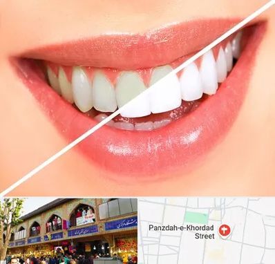 بلیچینگ دندان در 15 خرداد
