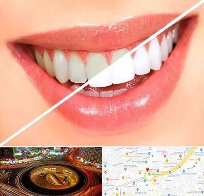 بلیچینگ دندان در میدان ولیعصر