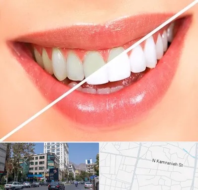 بلیچینگ دندان در کامرانیه