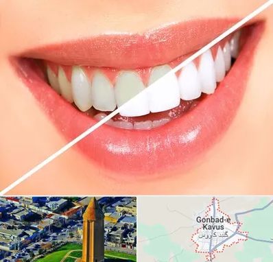 بلیچینگ دندان در گنبد کاووس
