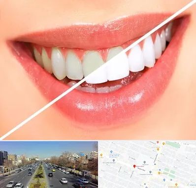بلیچینگ دندان در بلوار معلم مشهد