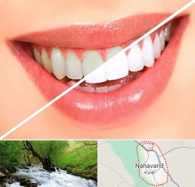 بلیچینگ دندان در نهاوند