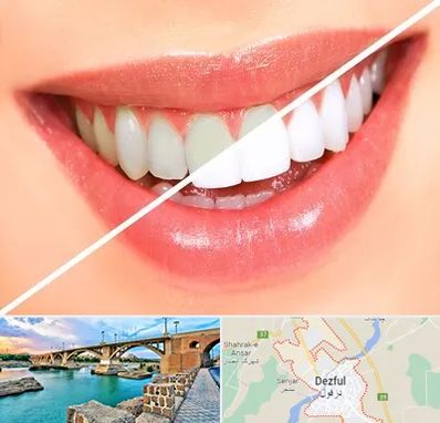 بلیچینگ دندان در دزفول