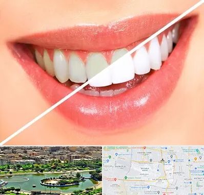 بلیچینگ دندان در منطقه 9 تهران
