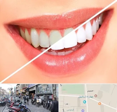 بلیچینگ دندان در چهارراه استانبول
