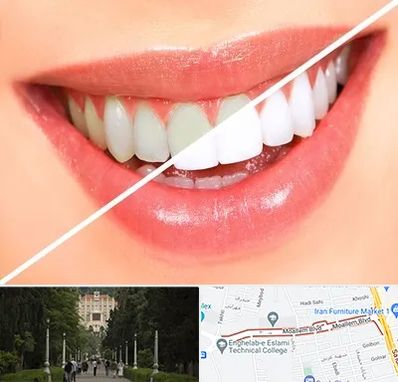 بلیچینگ دندان در بلوار معلم رشت 