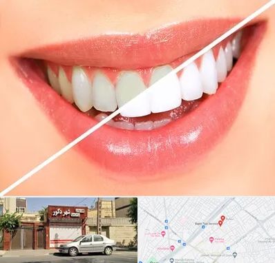 بلیچینگ دندان در باجک قم