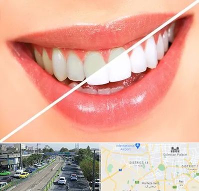 بلیچینگ دندان در جنوب تهران 