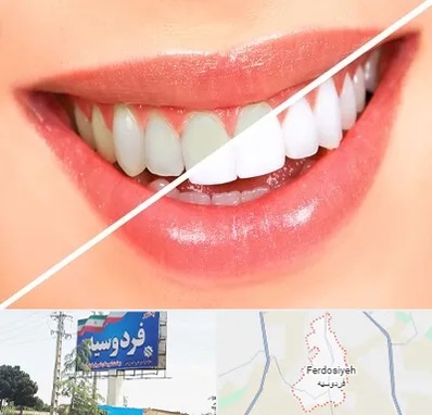 بلیچینگ دندان در فردوسیه شهریار