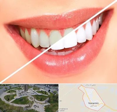 بلیچینگ دندان در ورامین