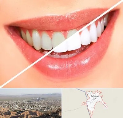 بلیچینگ دندان در اسفراین
