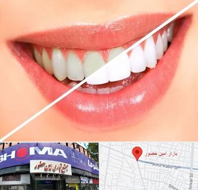 بلیچینگ دندان در امین حضور