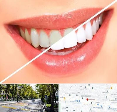 بلیچینگ دندان در میرداماد