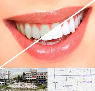 بلیچینگ دندان در مرکز تهران