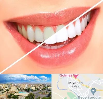 بلیچینگ دندان در میانه