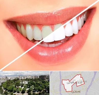 بلیچینگ دندان در نیروی هوایی