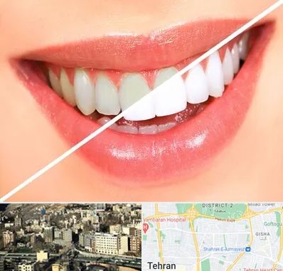 بلیچینگ دندان در مرزداران 