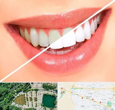 بلیچینگ دندان در وکیل آباد مشهد