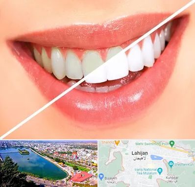 بلیچینگ دندان در لاهیجان