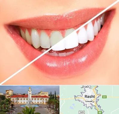 بلیچینگ دندان در رشت